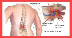 saraf kejepit adalah