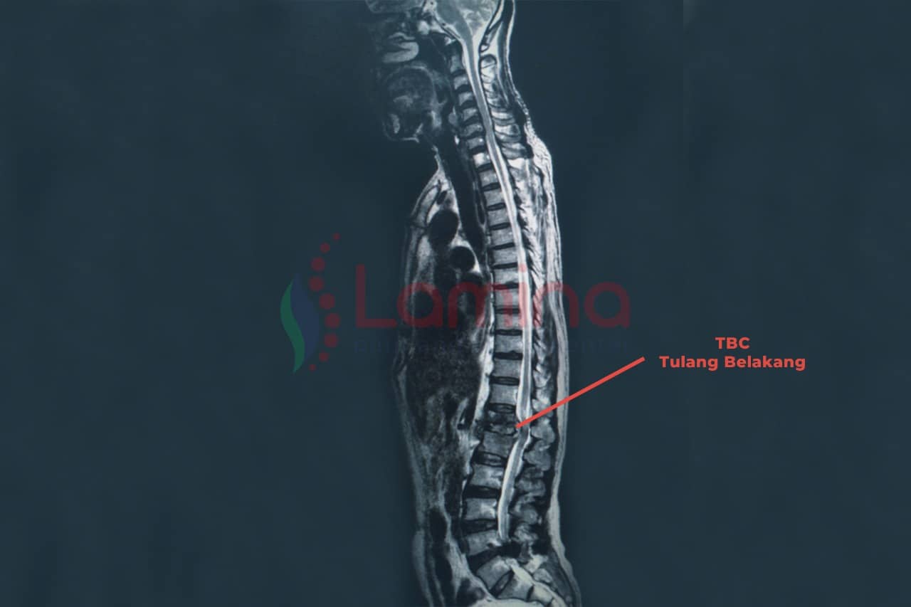 TBC tulang belakang adalah
