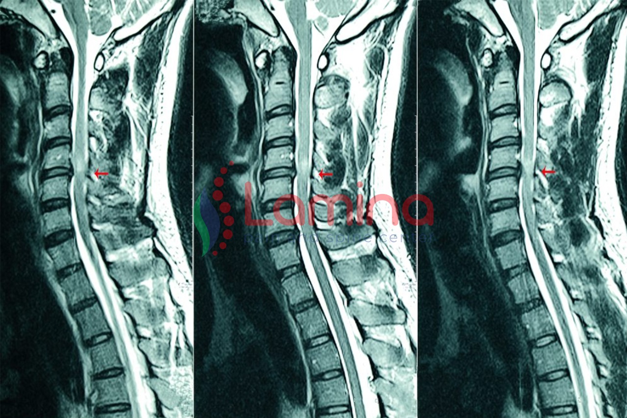 Scan MRI tulang belakang leher/punggung menunjukkan struktur tulang dan diskus