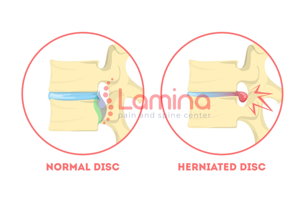 Diagram potongan diskus tulang belakang menunjukkan herniasi saraf