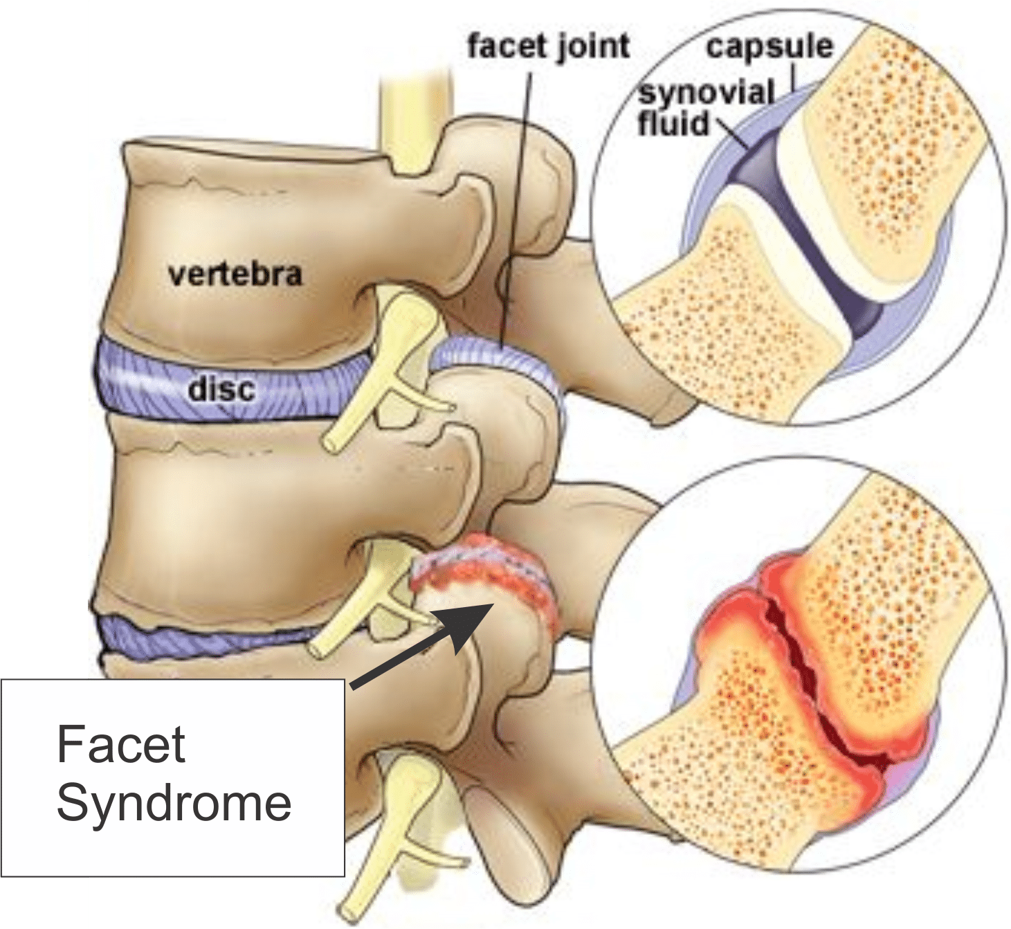 penyakit facet joint adalah