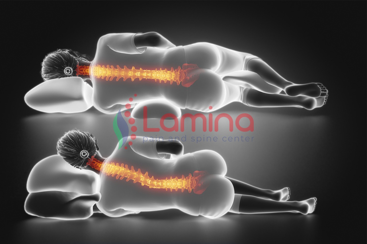 posisi tidur yang baik untuk skoliosis