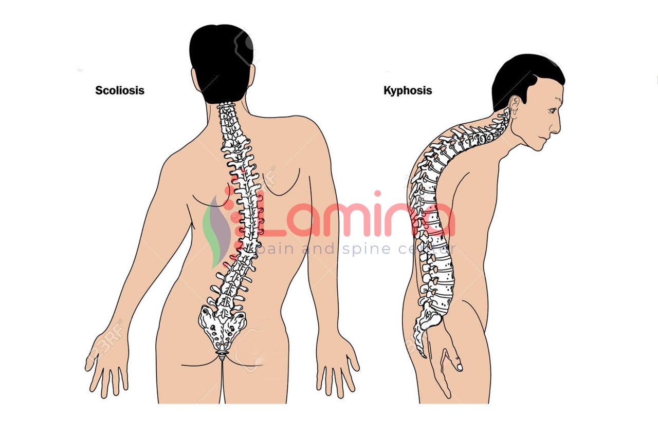 tulang belakang bengkok