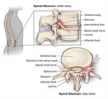 spinal stenosis