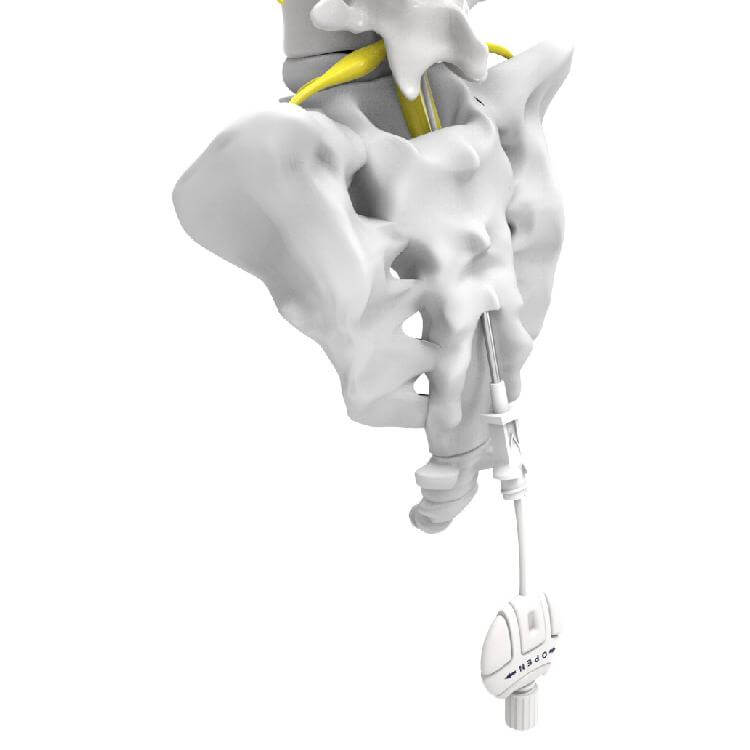 pengobatan saraf kejepit