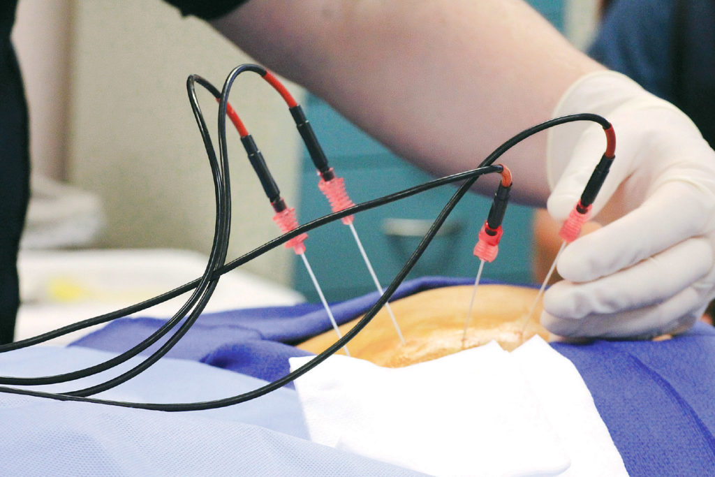 persiapan radiofrekuensi ablasi