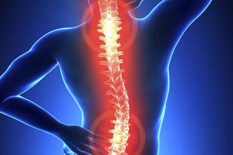 Ilustrasi saraf kejepit pada tulang belakang
